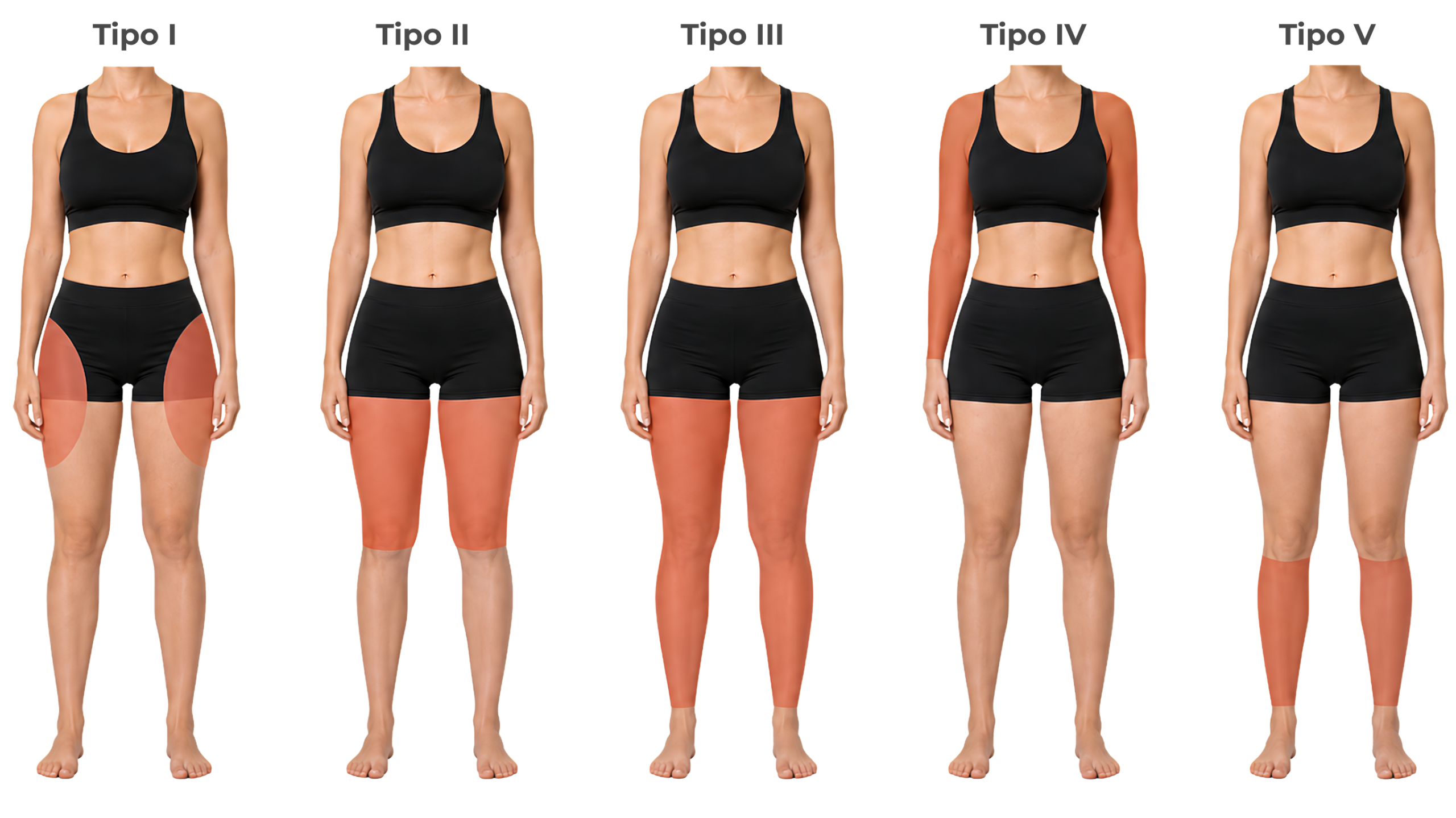 Tipos de lipedema